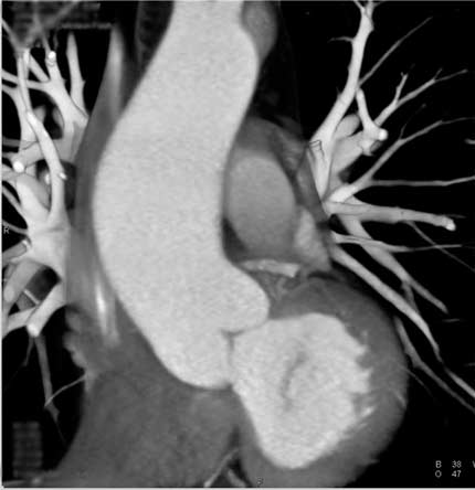 3D CTA image of the aorta