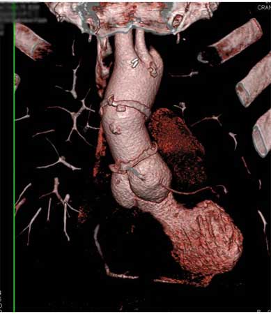 3-D CT angiography of the aorta.