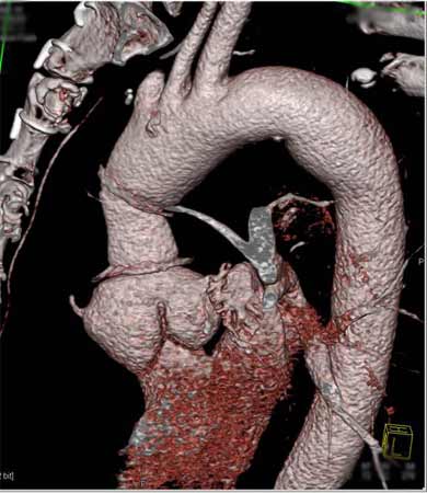 Imagen 3D de una angiotomógrafía de la aorta.