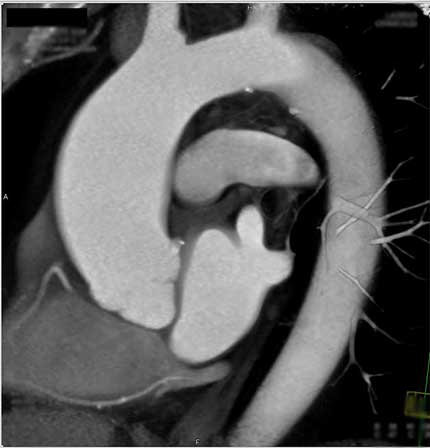 Angiotomografía computarizada 3D de la aorta