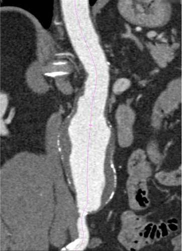 Angiotomografía computarizada de una aorta abdominal agrandada