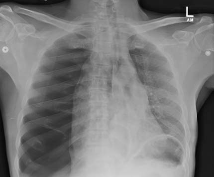 Radiograph of the chest 