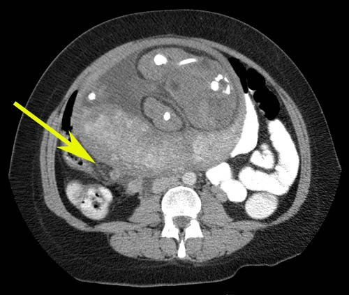 CT of the abdomen and pelvis