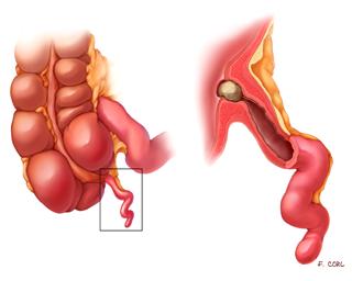 Ilustración que muestra apendicitis.