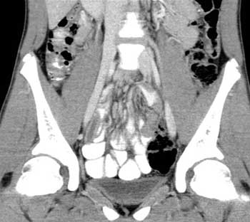 CT scan of an obstructed appendix
