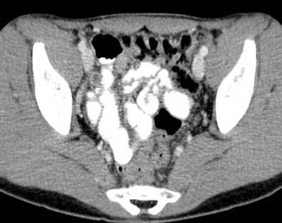 CT scan of an obstructed appendix.