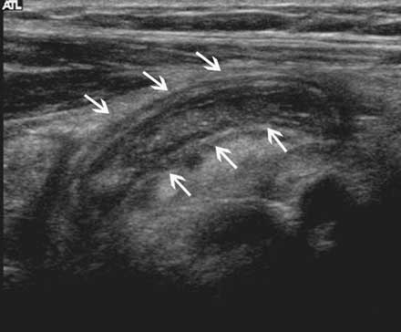 Imagen por ultrasonido mostrando un apéndice inflamado . 