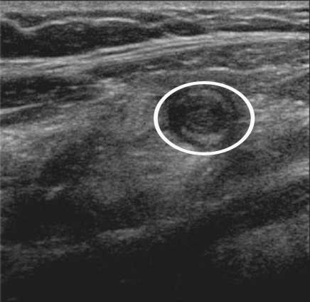 Ultrasound of a swollen appendix