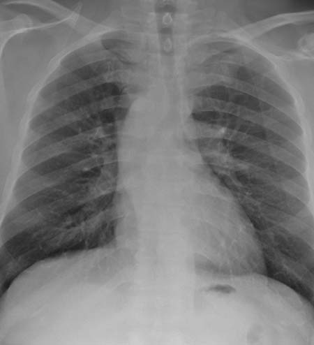Chest X-ray showing aortic arch