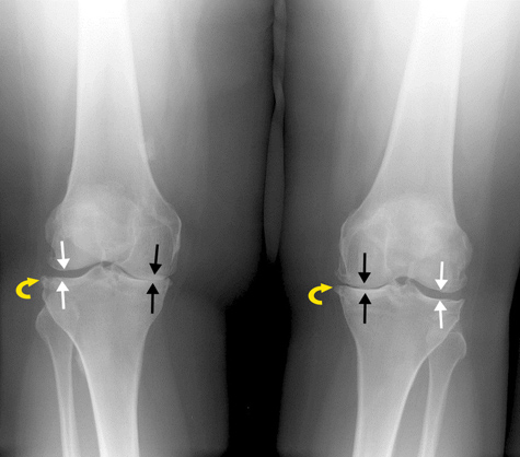  Radiografía de rodilla que muestra osteoartritis.