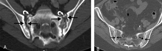 CT images of the sacroiliac joints.