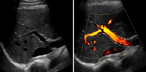  Ultrasonido que muestra el flujo sanguíneo de los intestinos al hígado