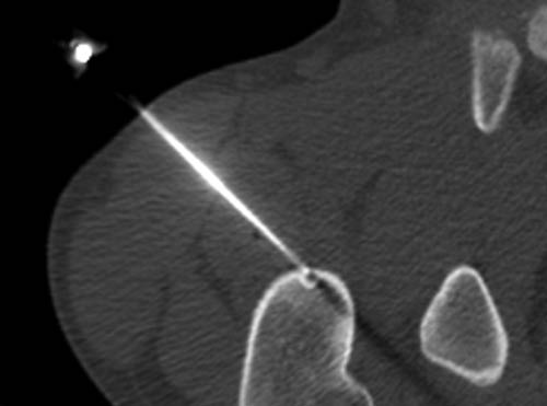 CT  showing  bone biopsy entry spot