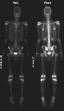 Normal bone scan of a young boy
