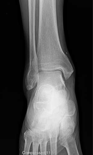 Ankle x-ray