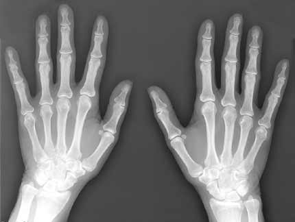 X-ray of both hands