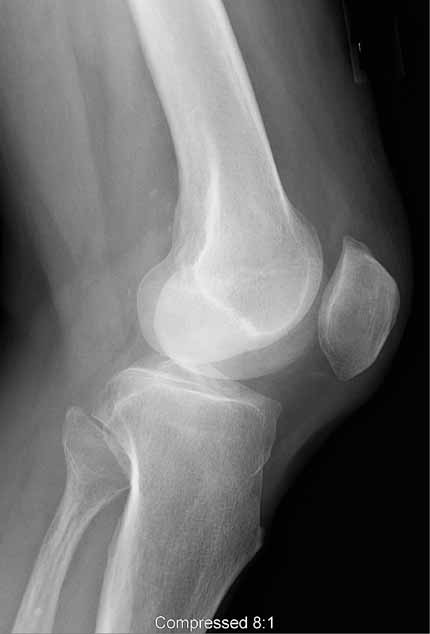 Radiografía de rodilla