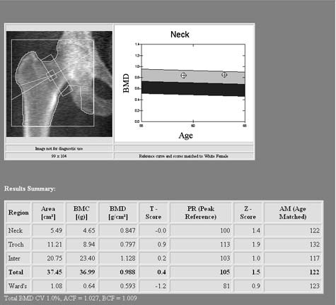Estudio típico de densitometría ósea
