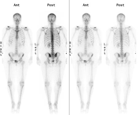 image of a normal bone scan.