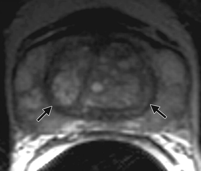 MRI que muestra nódulos de BPH en la próstata.