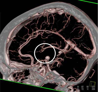 Angiotomografía computarizada mostrando un aneurisma cerebral 