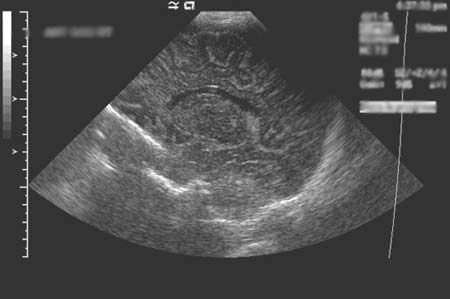 Ultrasound image of a child's brain.