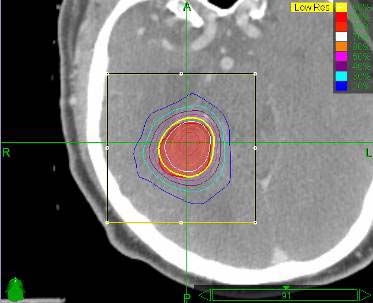 Stereotactic radiation therapy delivered to part of the brain.