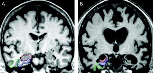  Imagen de resonancia magnética que muestra regiones del cerebro.