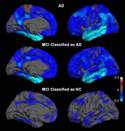 MRI image shows differences in brain thickness for patient's with Alzheimer’s disease (AD) and mild cognitive impairment (MCI). 