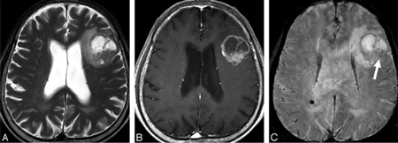 Imágenes de resonancia magnética que muestran un tumor cerebral metastásico.