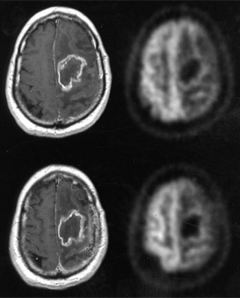 PET/CT scan showing a brain tumor.