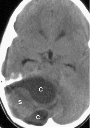 Imagen de TC que muestra un tumor cerebral.