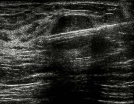 Imagen de una biopsia de seno guiada por ultrasonido mostrando la aguja de biopsia
