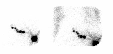 Nuclear Medicine Breast Lymphoscintigraphy