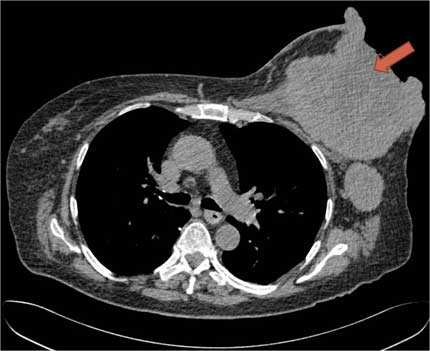 CT scan: breast tumor