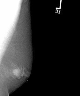 Mammography - male breast