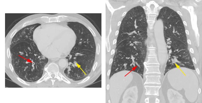  Tomografía computarizada que muestra bronquitis crónica.