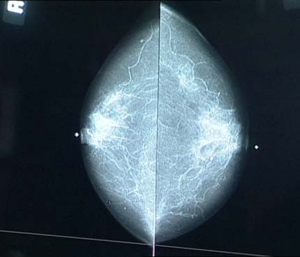 Mamografía de detección asistida por computadora (CAD)