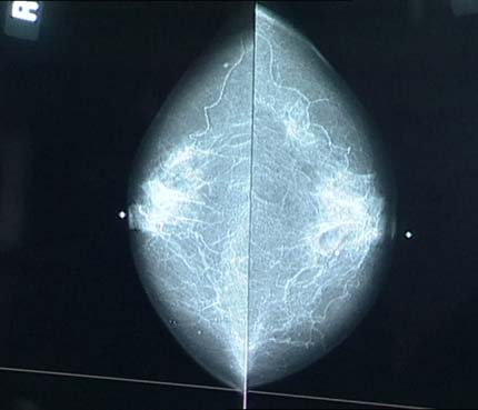 Computer-aided detection (CAD) mammogram