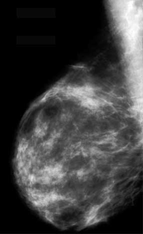 Normal mammogram