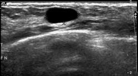 Ultrasound image of a benign breast cyst