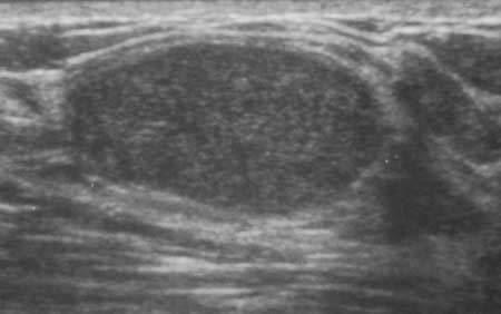 Benign fibroadenoma ultrasound