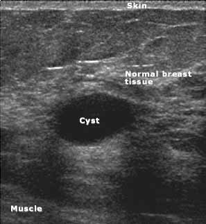 Imagen de ultrasonido que muestra un quiste benigno en la mama derecha.