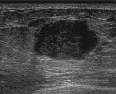 Ultrasound image showing a solid mass in a breast