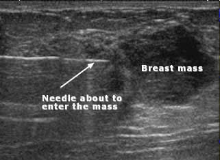 Ultrasound image showing a biopsy needle entering a breast mass