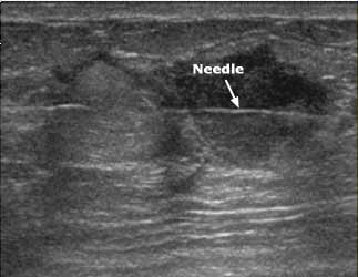 Ultrasound image showing a biopsy needle that has passed through a breast mass