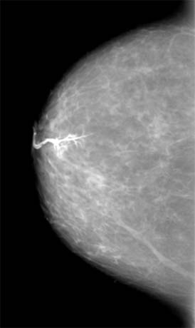 A galactogram showing a papilloma.