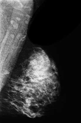 Normal mammogram of a heterogeneously dense breast