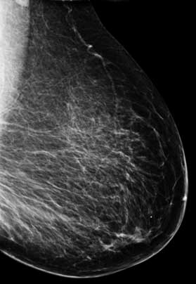 Normal mammogram of a fatty breast