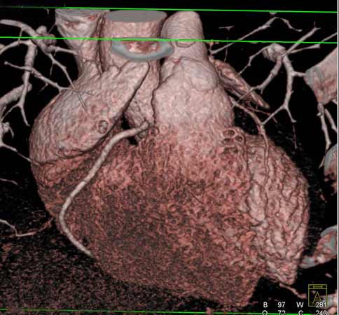  Imagen de angiografía por TC del corazón.